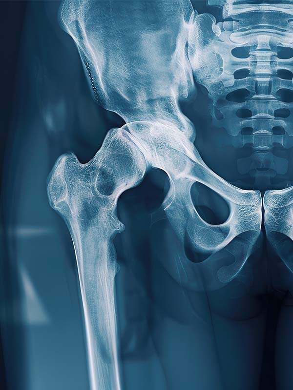 שחיקת מפרק הירך HIP OSTEOARTHROSIS